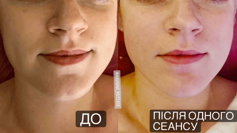 Буккальный массаж лица: почему эта "скульптурная" техника так популярна. Плюсы, минусы, подводные камни