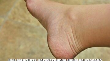 КАК СМЯГЧИТЬ ЗАГРУБЕВШУЮ КОЖУ НА СТОПАХ? 3 совета Яичный желток смешать с 1 ч….